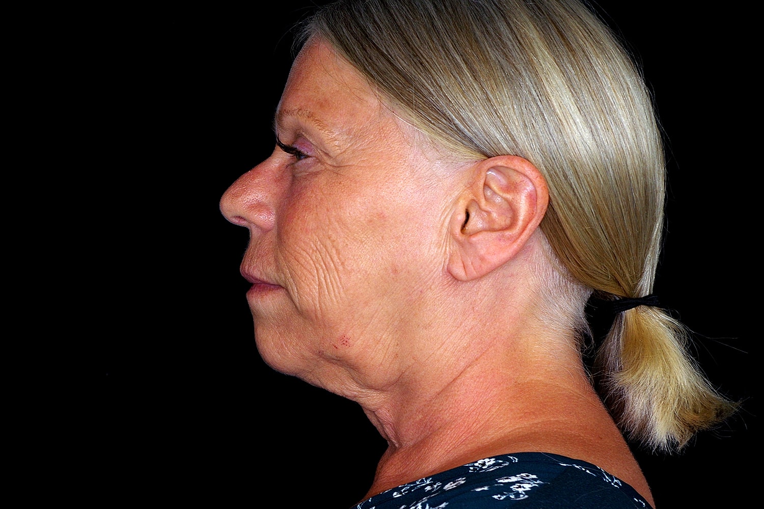 Facelift Before & After