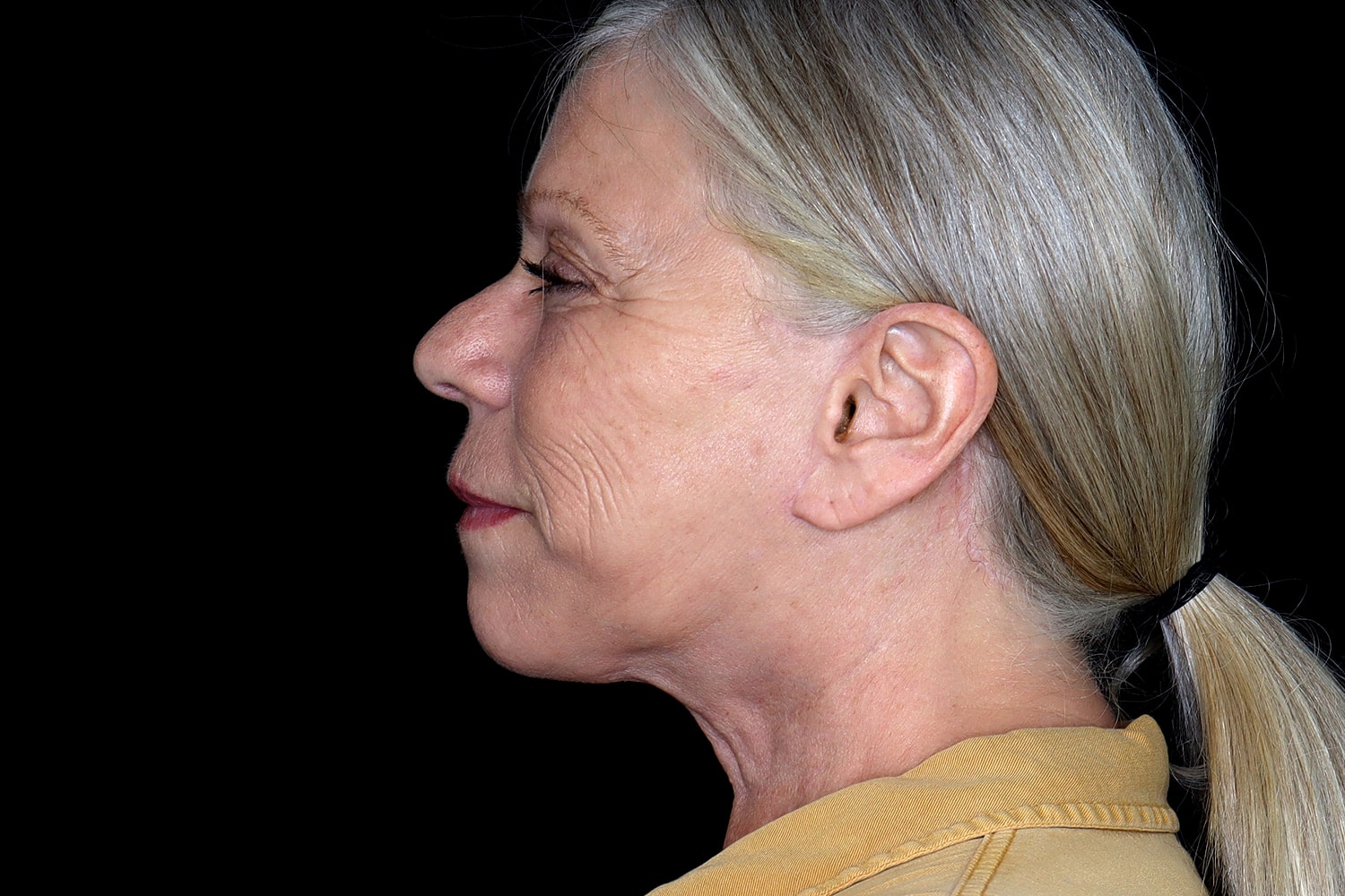Facelift Before & After