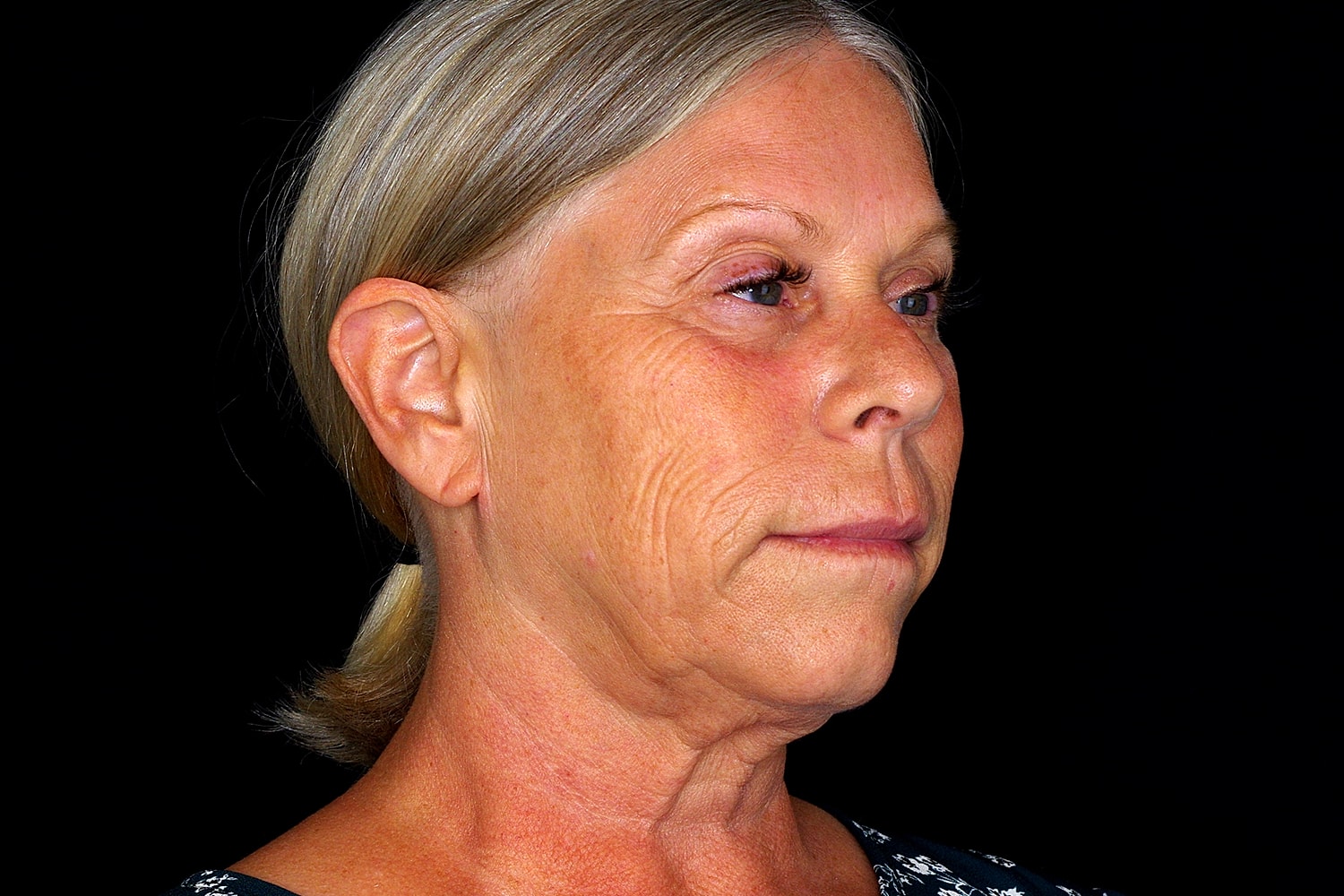 Facelift Before & After