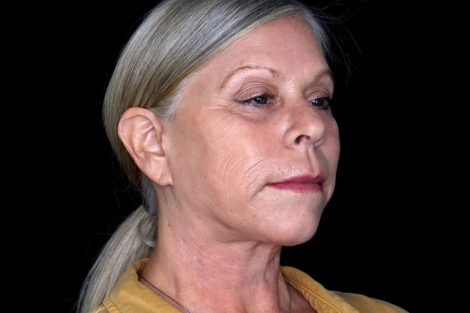 Facelift Before & After