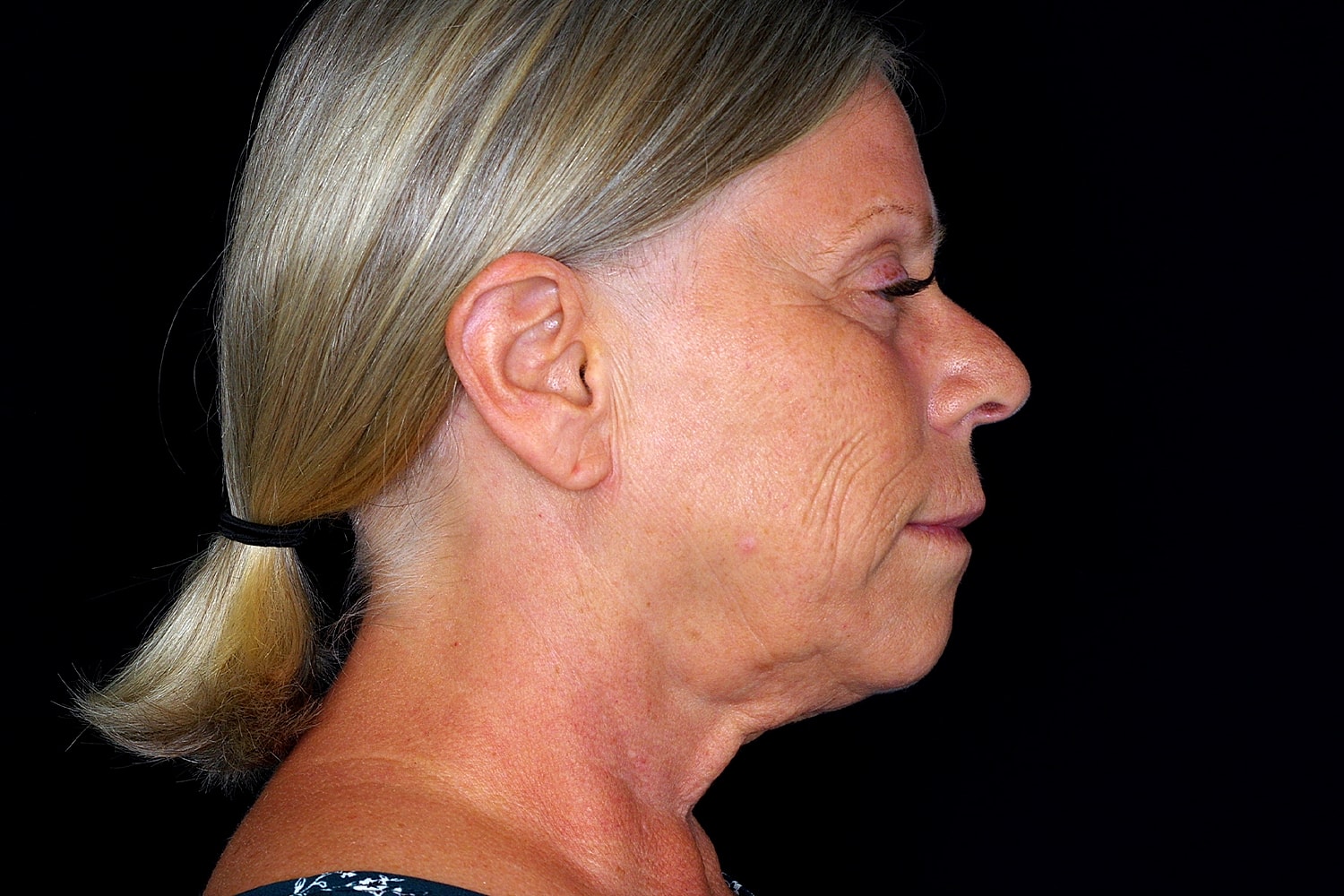 Facelift Before & After
