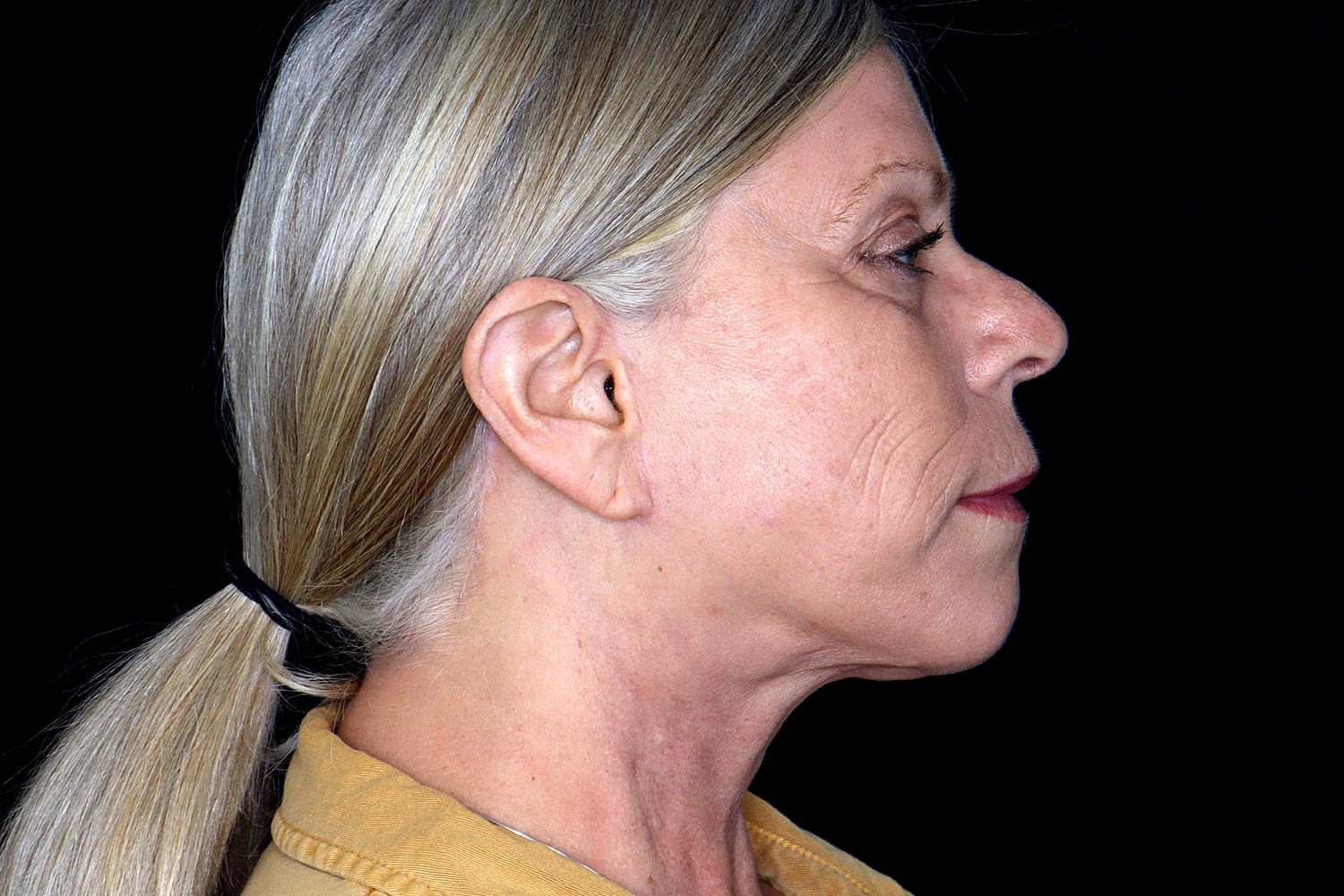 Facelift Before & After