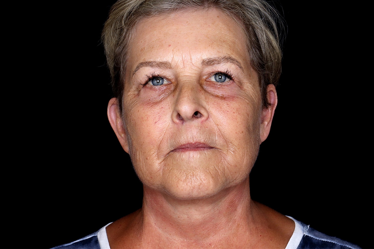 Facelift Before & After