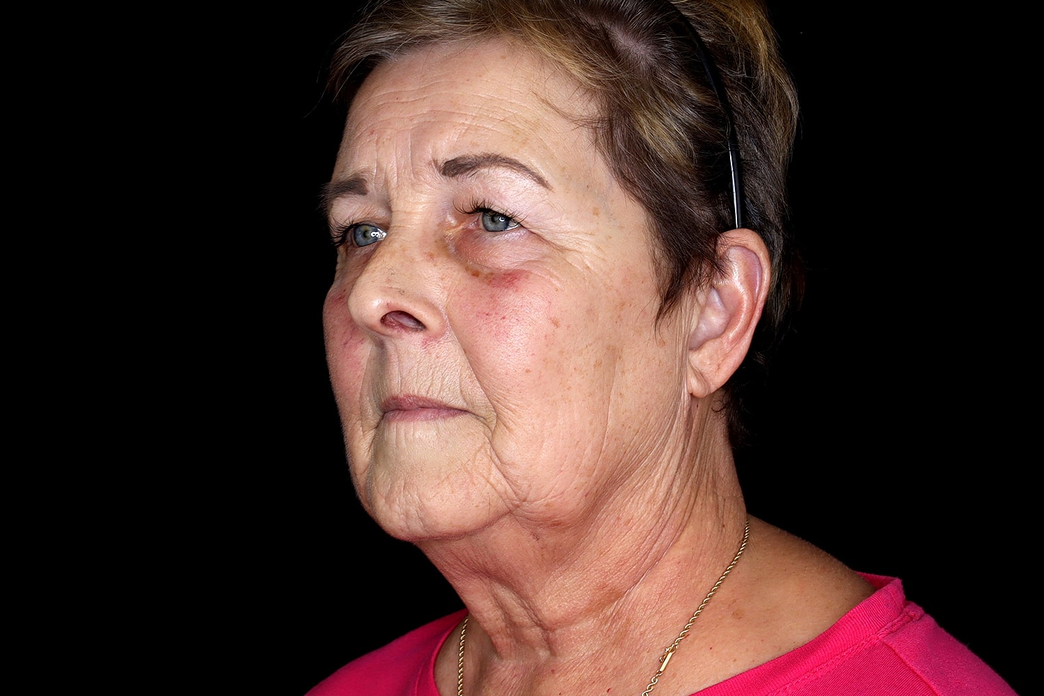 Facelift Before & After
