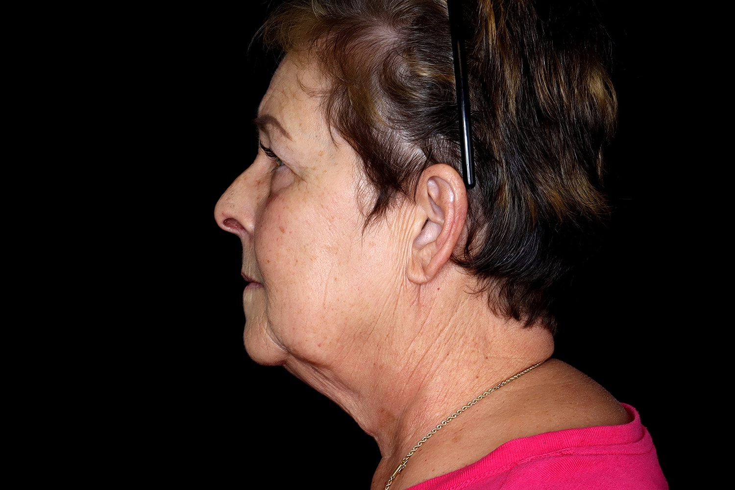 Facelift Before & After
