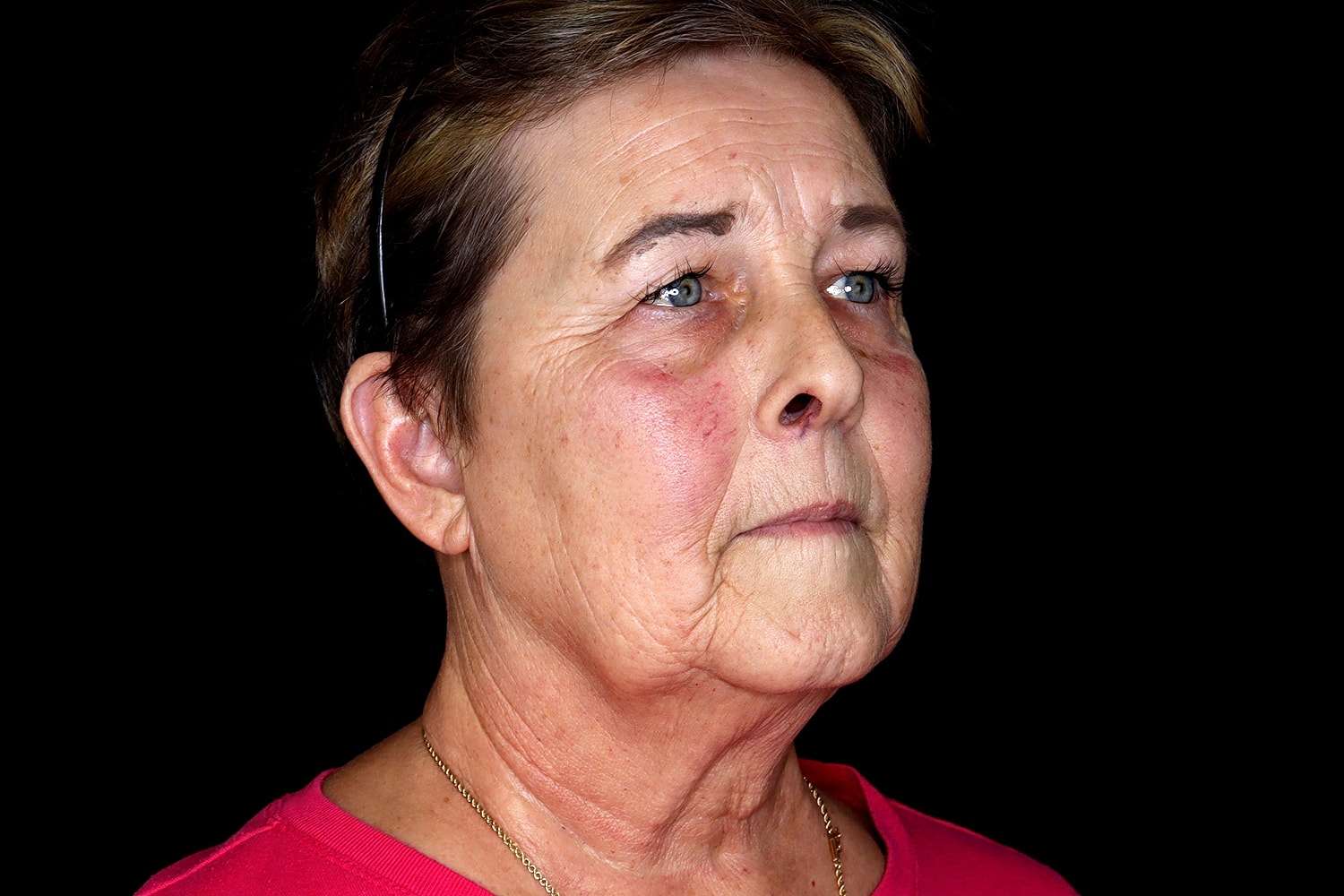 Facelift Before & After