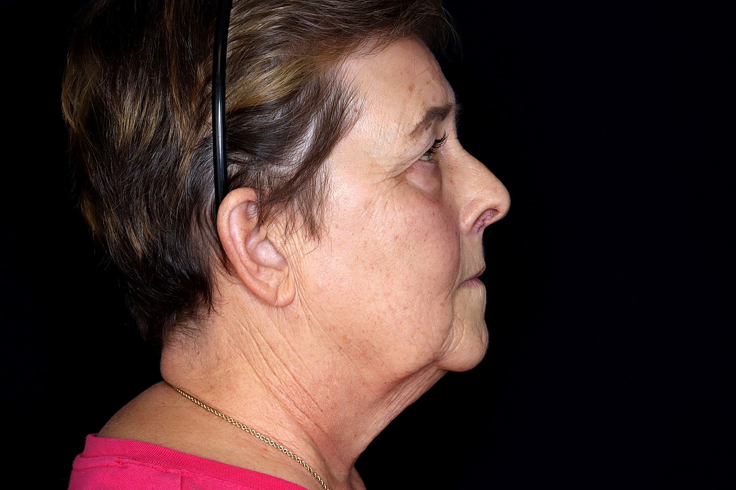 Facelift Before & After