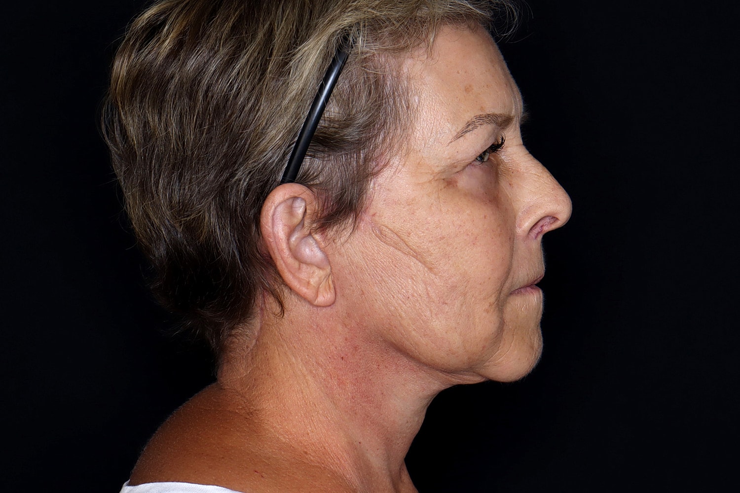 Facelift Before & After