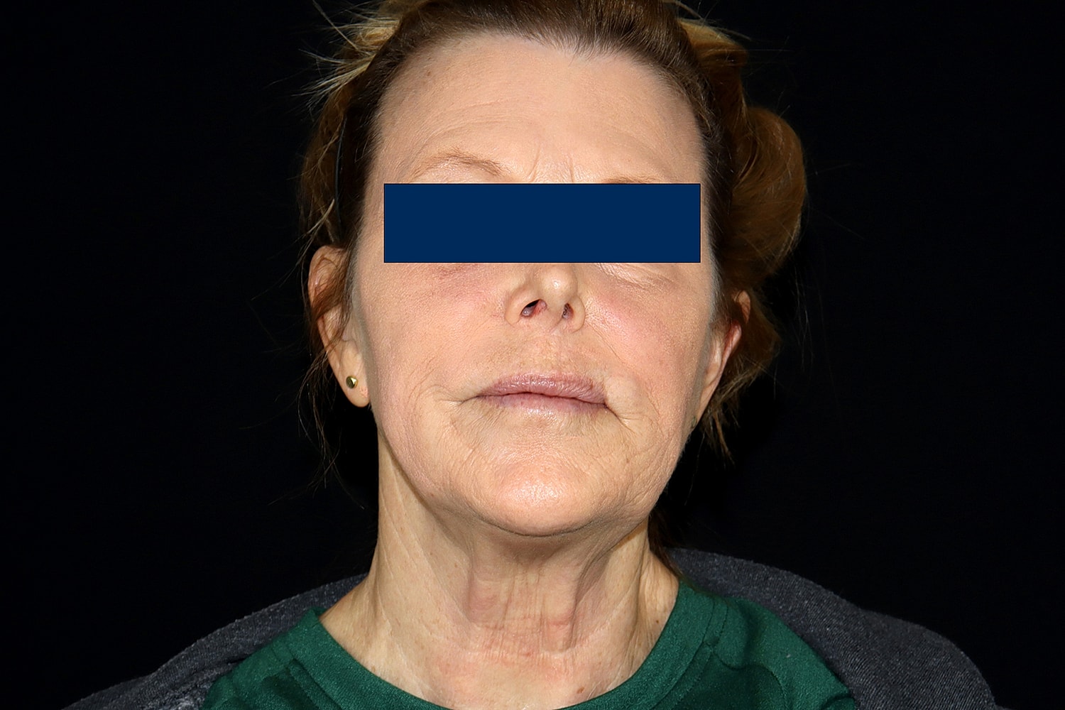 Facelift Before & After
