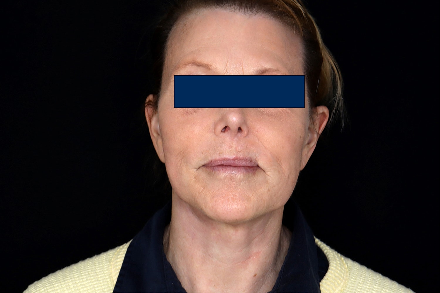 Facelift Before & After