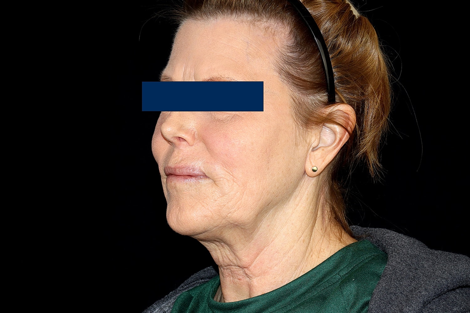 Facelift Before & After