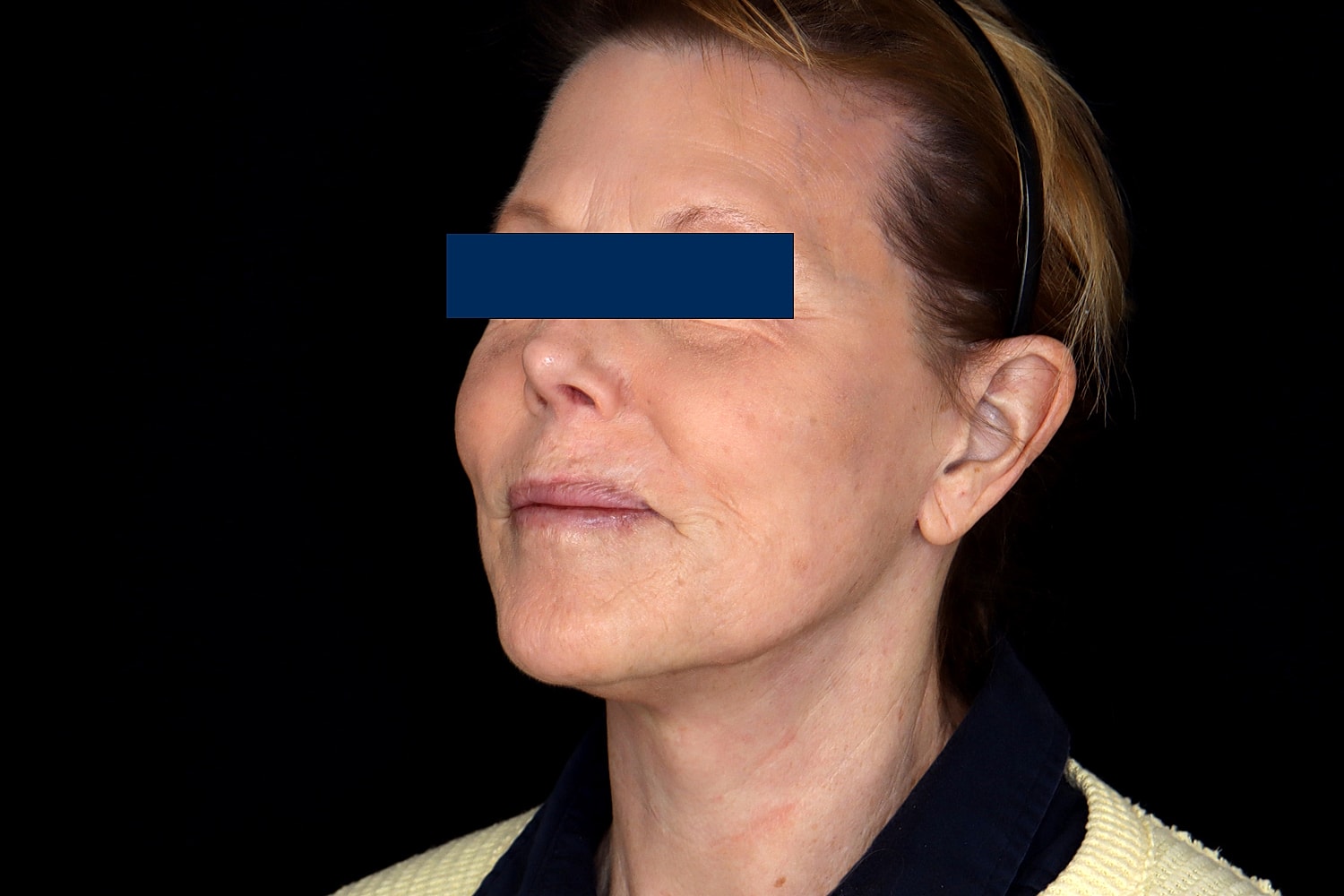Facelift Before & After