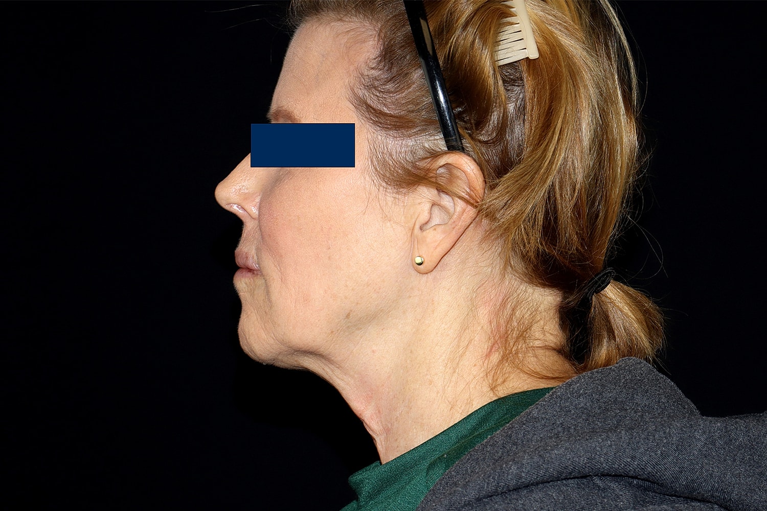Facelift Before & After