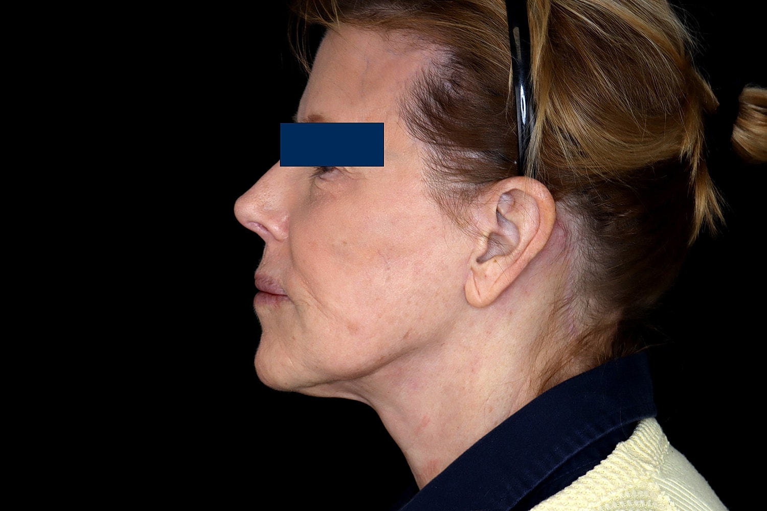 Facelift Before & After