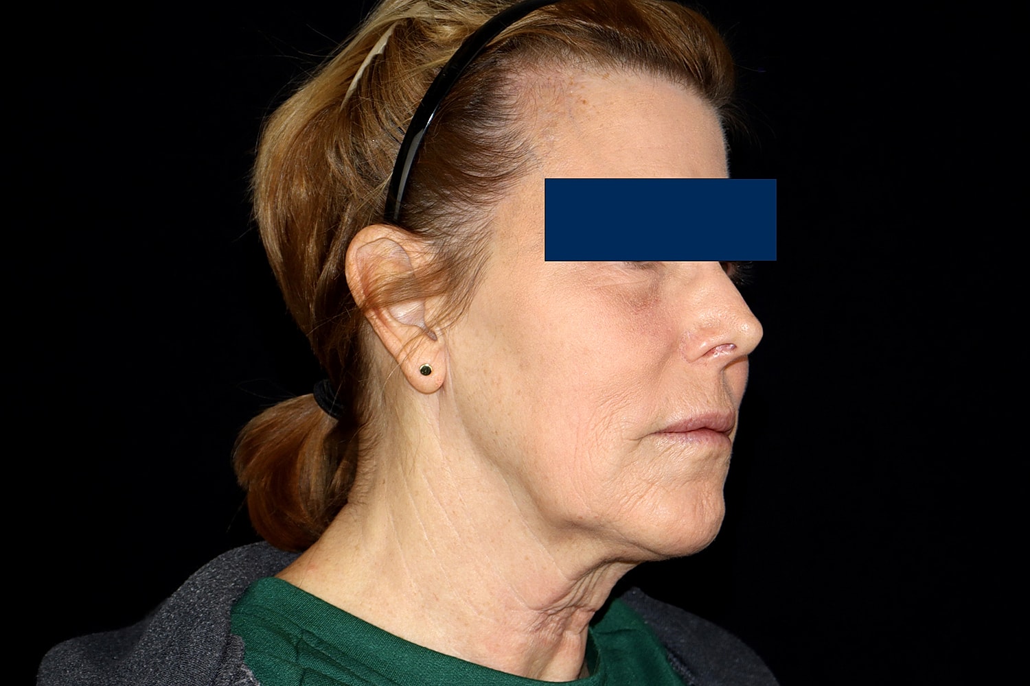 Facelift Before & After