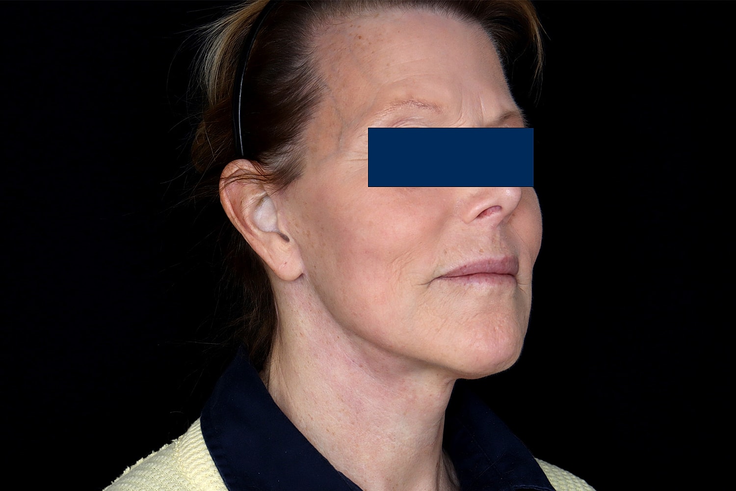 Facelift Before & After