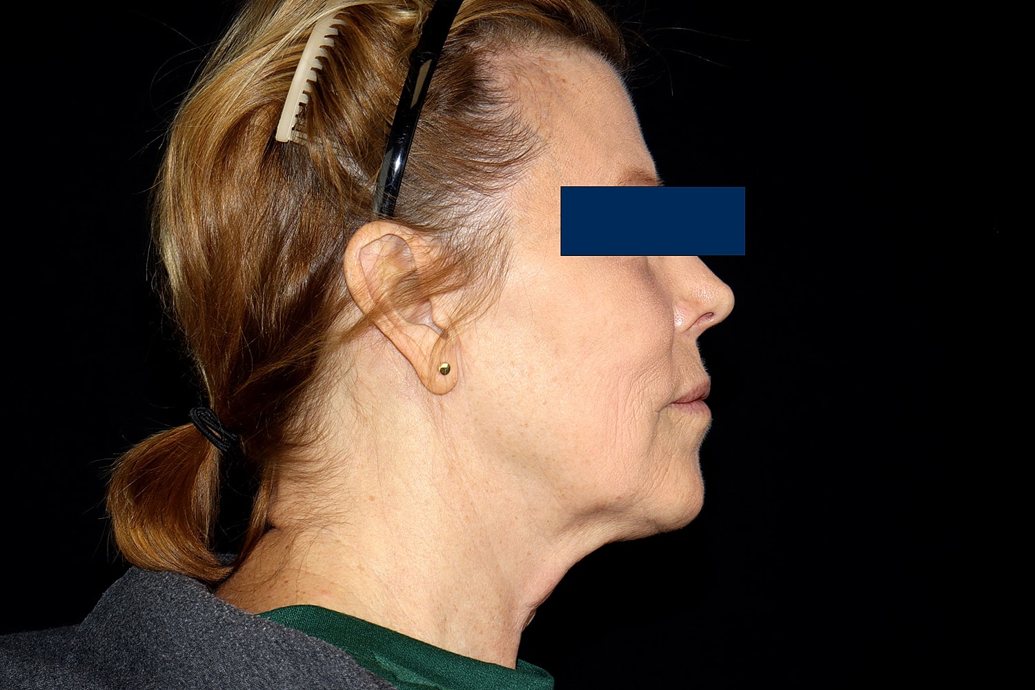 Facelift Before & After