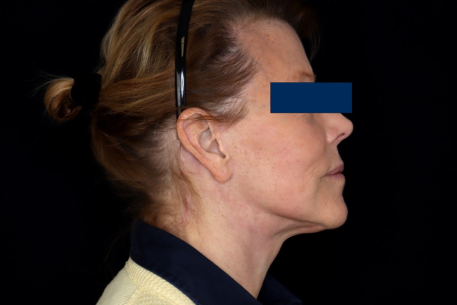 Facelift Before & After