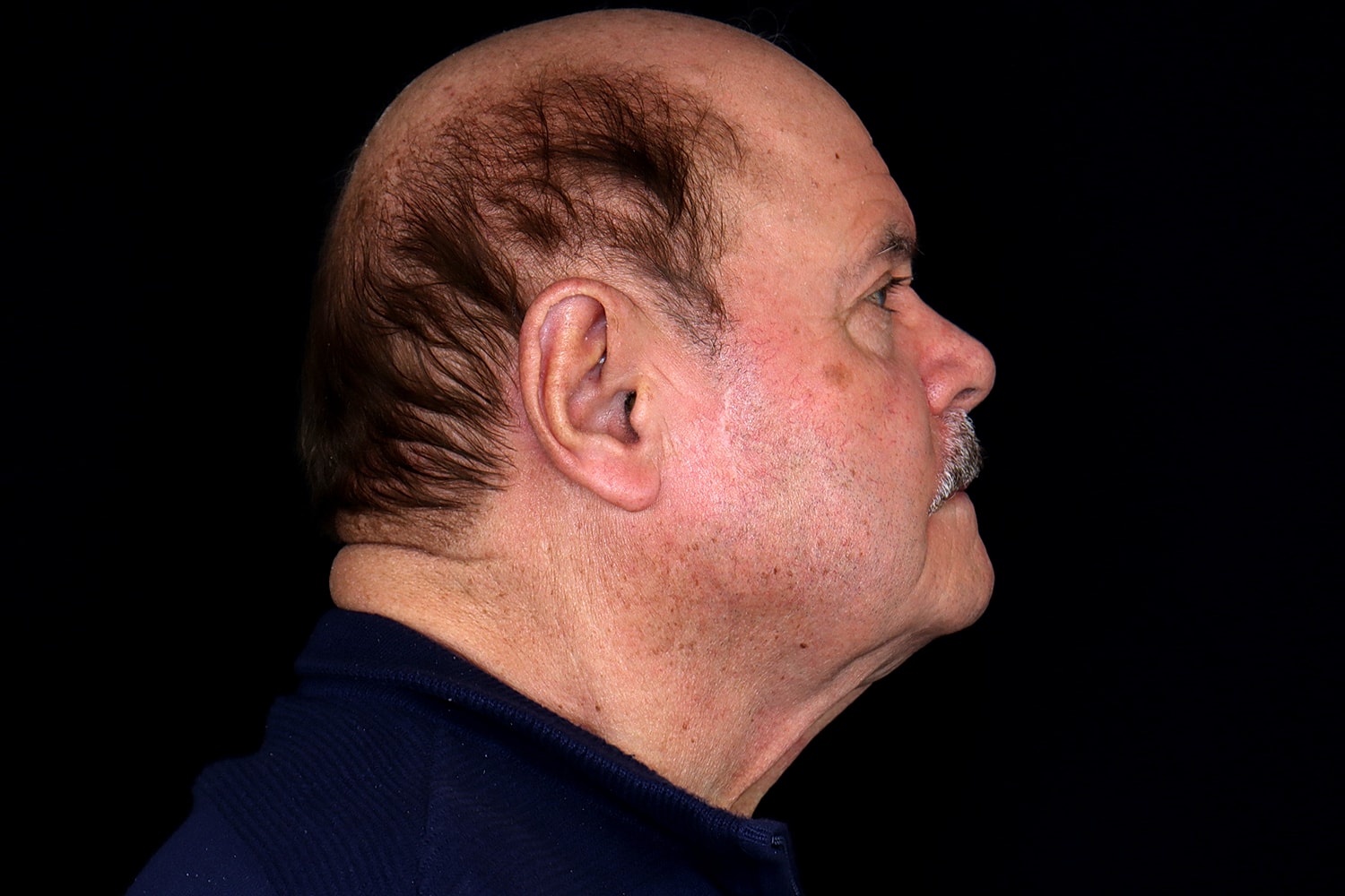 Facelift Before & After