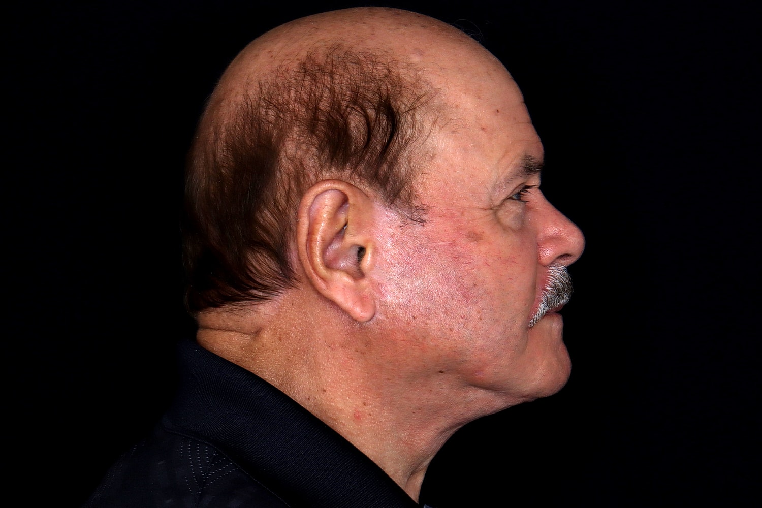 Facelift Before & After