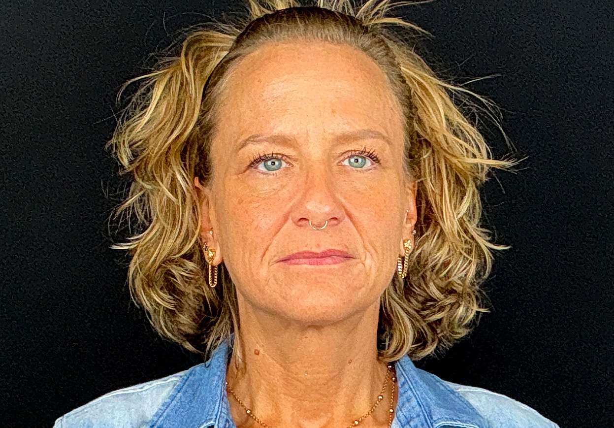 Facelift Before & After