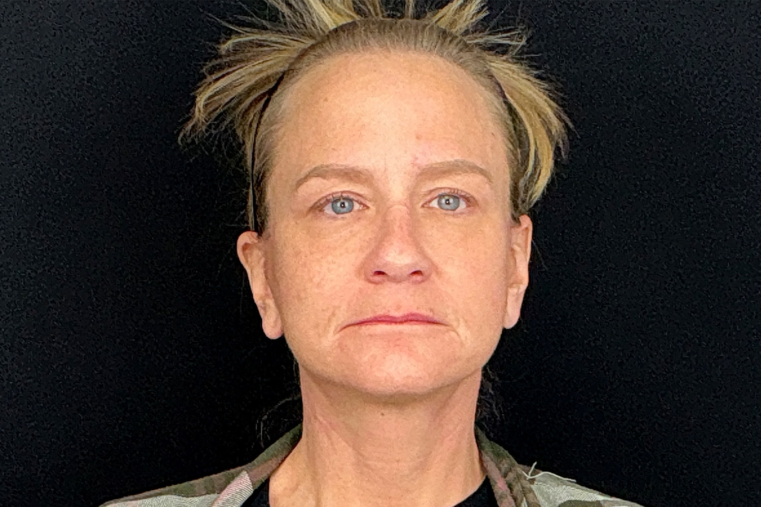 Facelift Before & After