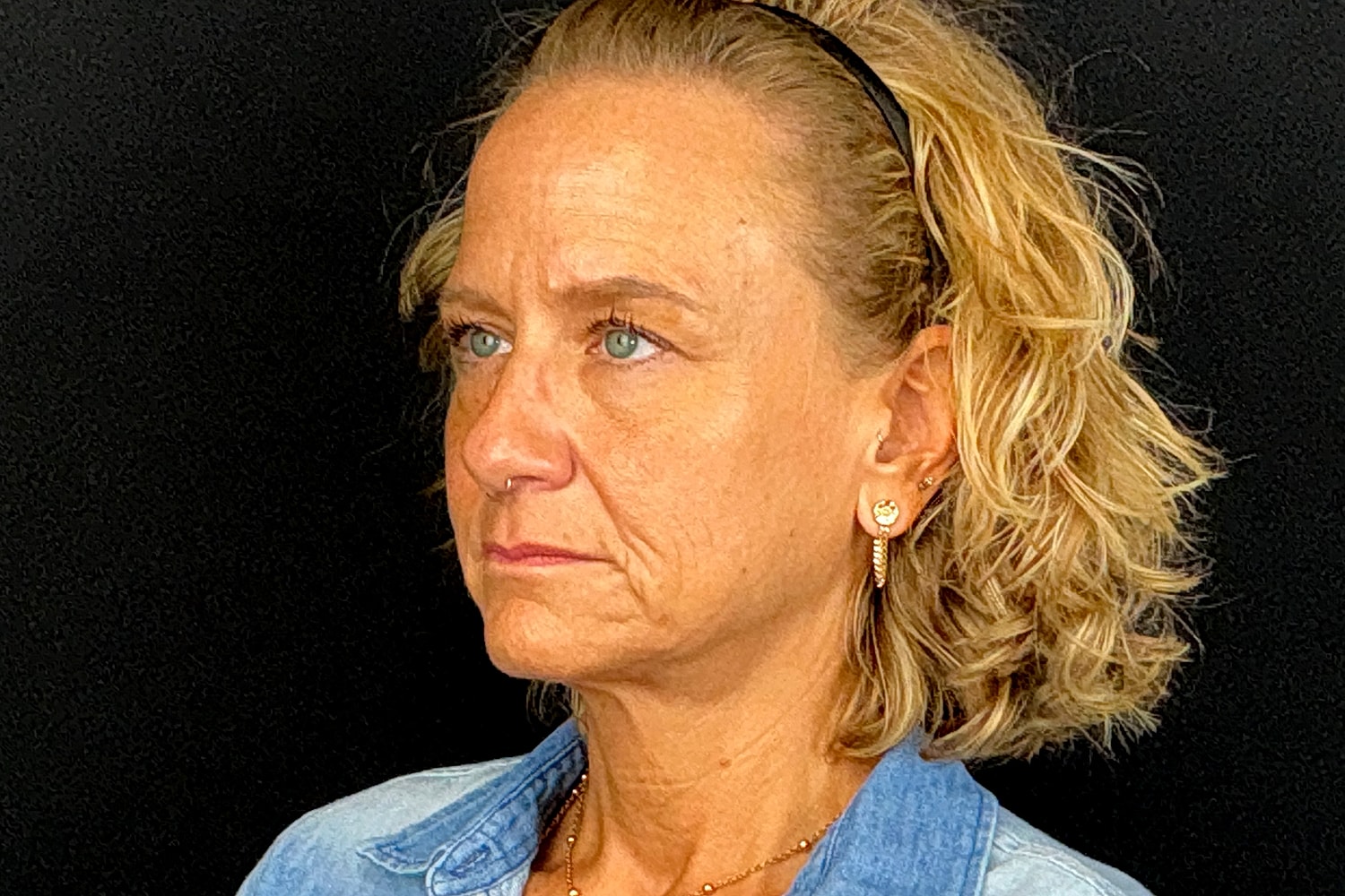 Facelift Before & After