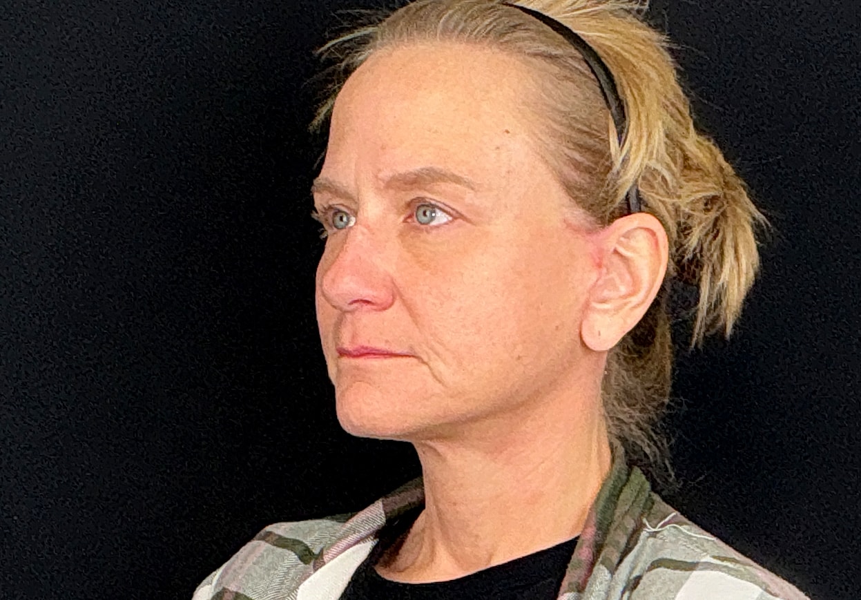 Facelift Before & After