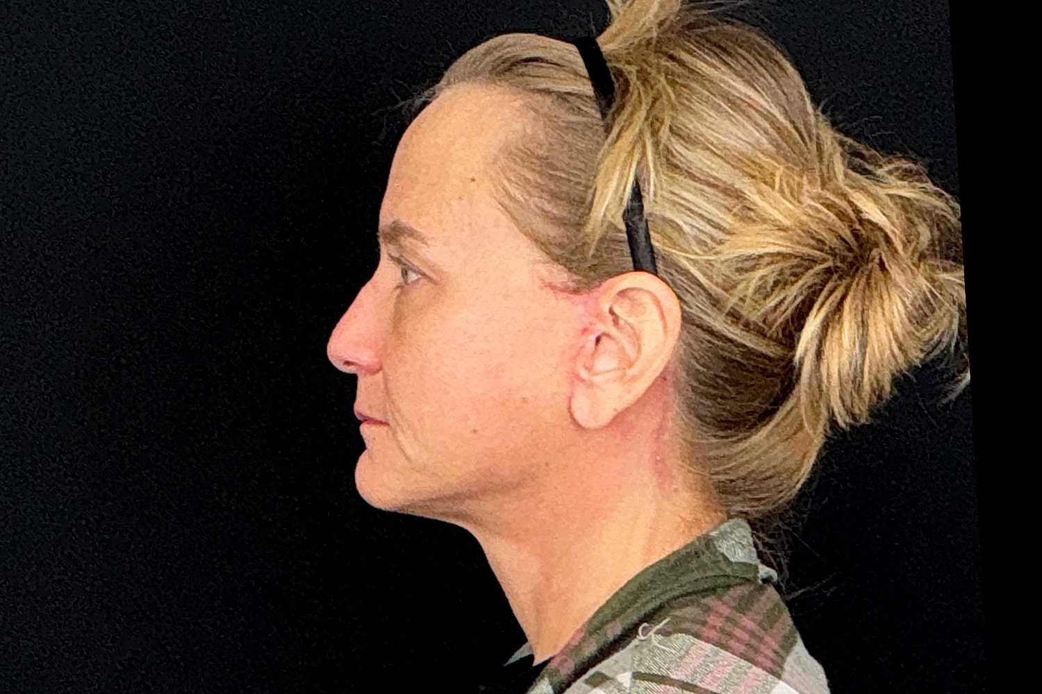 Facelift Before & After