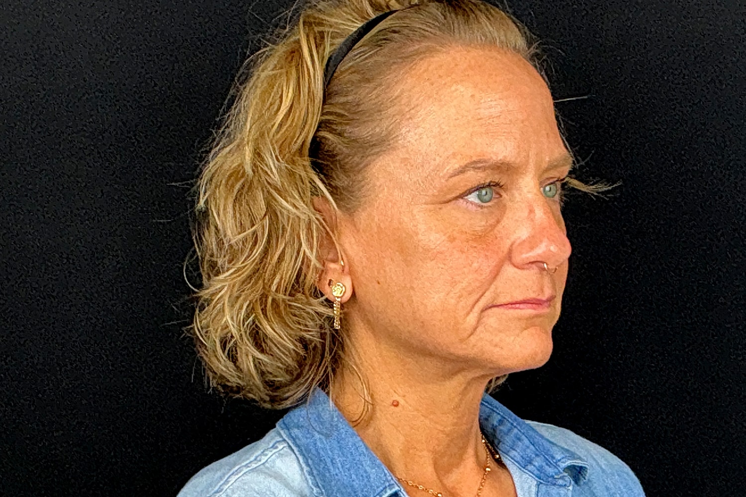 Facelift Before & After