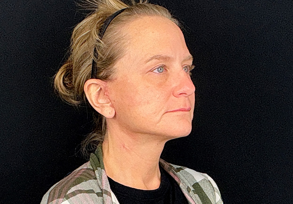 Facelift Before & After