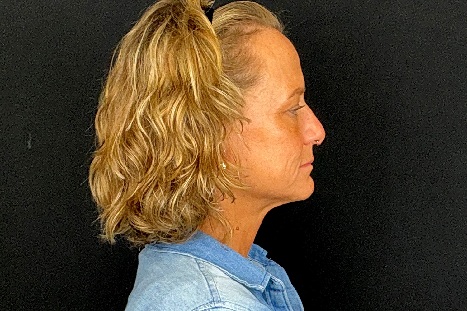 Facelift Before & After