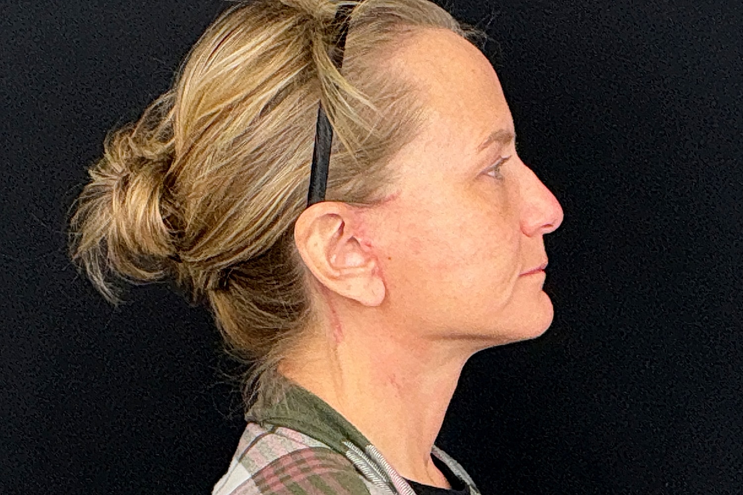 Facelift Before & After